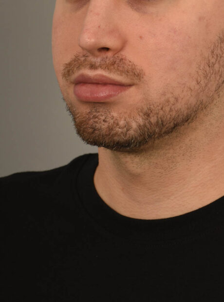 Deep Neck Contouring case #11338