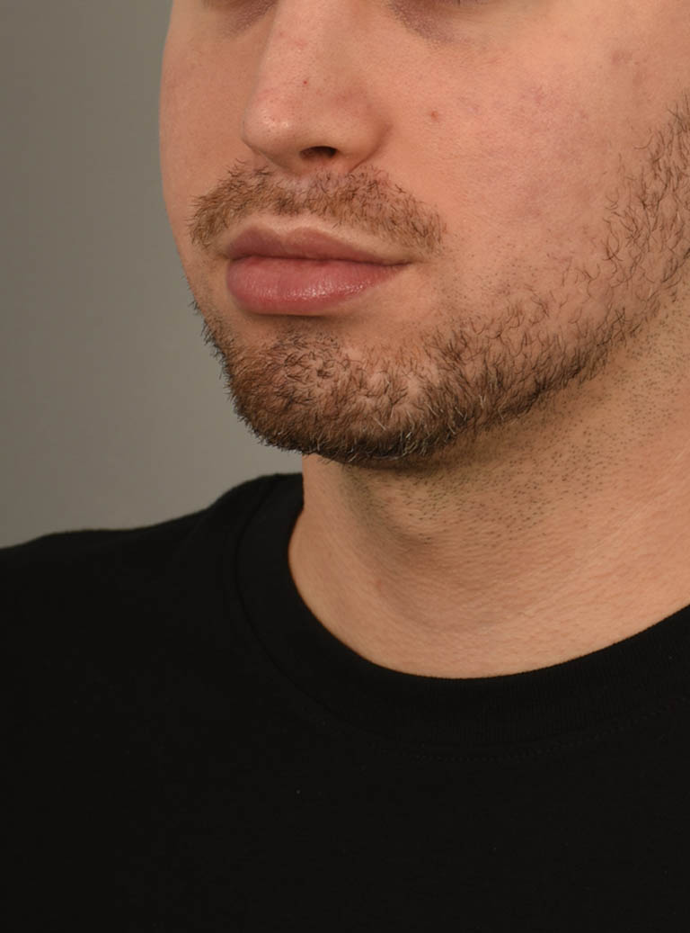Deep Neck Contouring case #11338