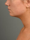 Deep Neck Contouring case #11302