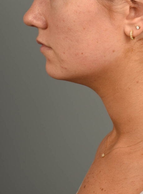 Deep Neck Contouring case #11302
