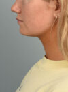 Deep Neck Contouring case #11302