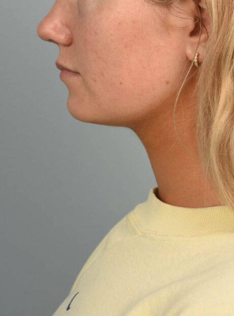 Deep Neck Contouring case #11302