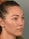 Rhinoplasty case #11708