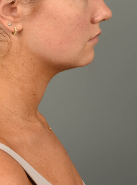 Deep Neck Contouring case #11302