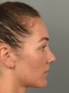 Rhinoplasty case #11708