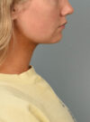 Deep Neck Contouring case #11302
