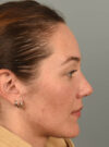 Rhinoplasty case #11708