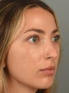 Eyelid Surgery case #11806