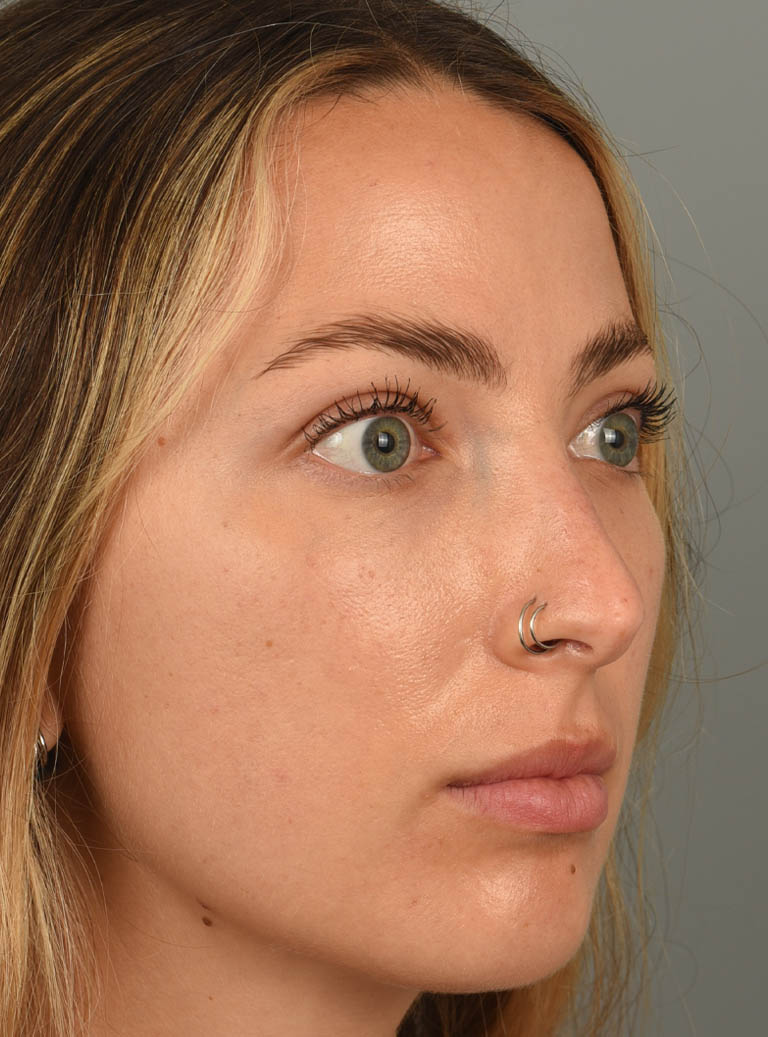 Eyelid Surgery case #11806