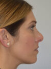 Rhinoplasty case #11703