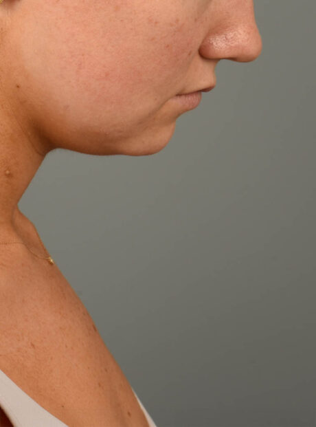 Deep Neck Contouring case #11302