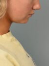 Deep Neck Contouring case #11302