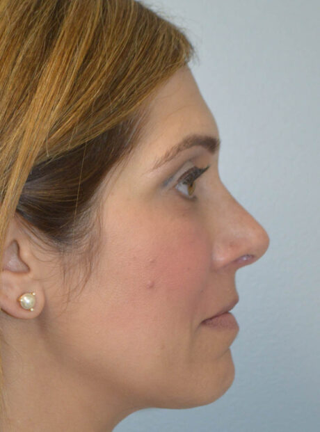 Rhinoplasty case #11703