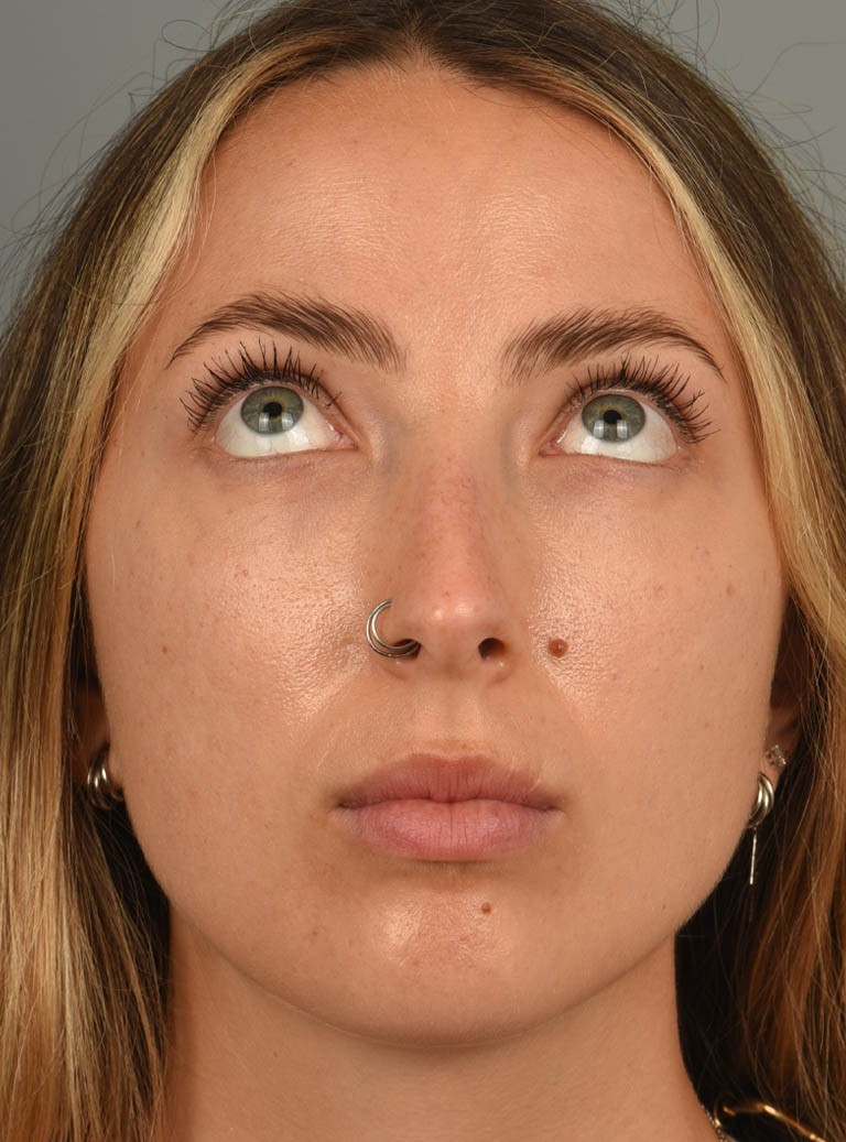 Eyelid Surgery case #11806