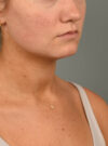 Deep Neck Contouring case #11302
