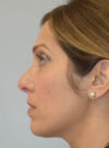 Rhinoplasty case #11703