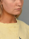 Deep Neck Contouring case #11302