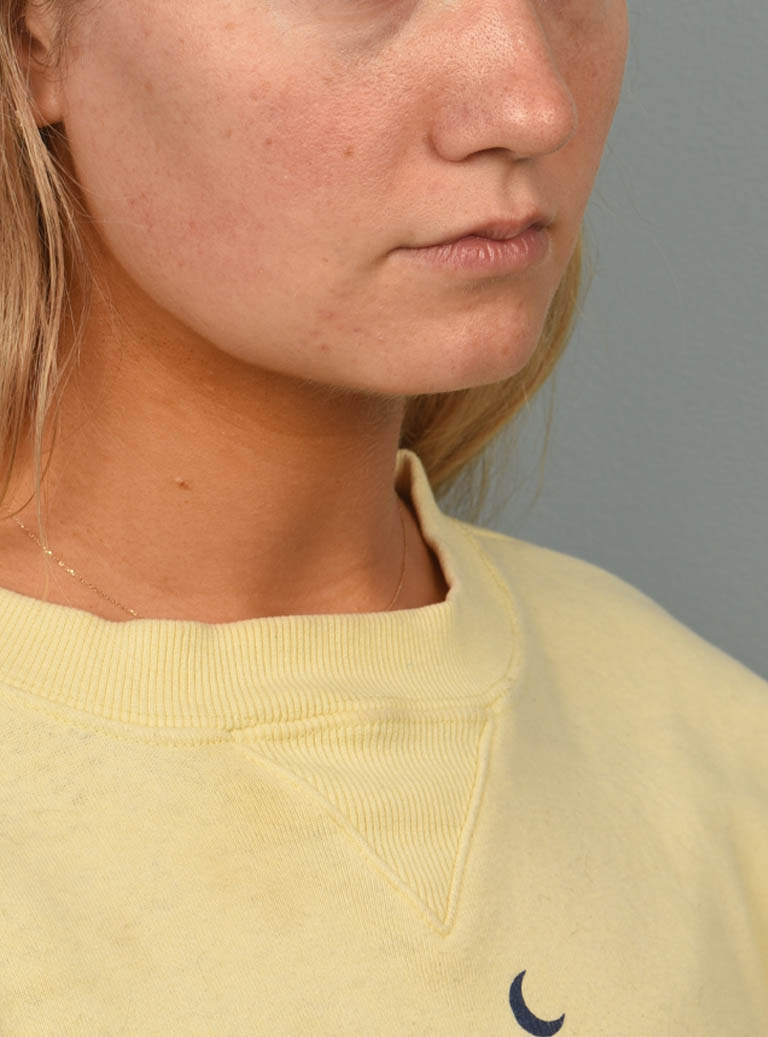 Deep Neck Contouring case #11302