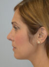 Rhinoplasty case #11703