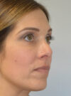 Rhinoplasty case #11703