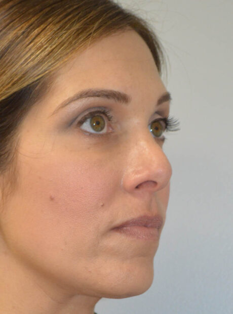 Rhinoplasty case #11703
