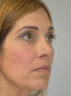 Rhinoplasty case #11703