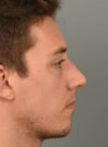Rhinoplasty case #11713