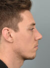Rhinoplasty case #11713