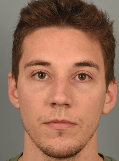 Rhinoplasty case #11713