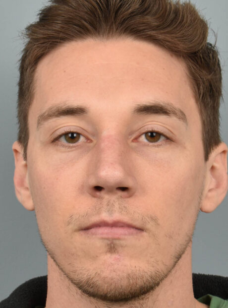 Rhinoplasty case #11713