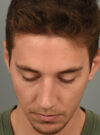 Rhinoplasty case #11713