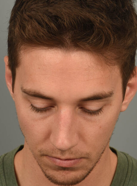 Rhinoplasty case #11713