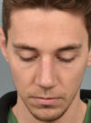 Rhinoplasty case #11713