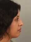 Rhinoplasty case #11710