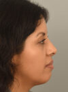 Rhinoplasty case #11710