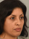Rhinoplasty case #11710