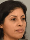 Rhinoplasty case #11710