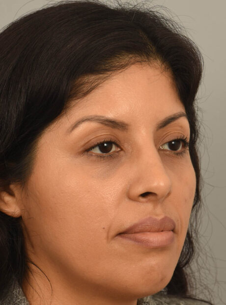 Rhinoplasty case #11710