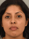 Rhinoplasty case #11710