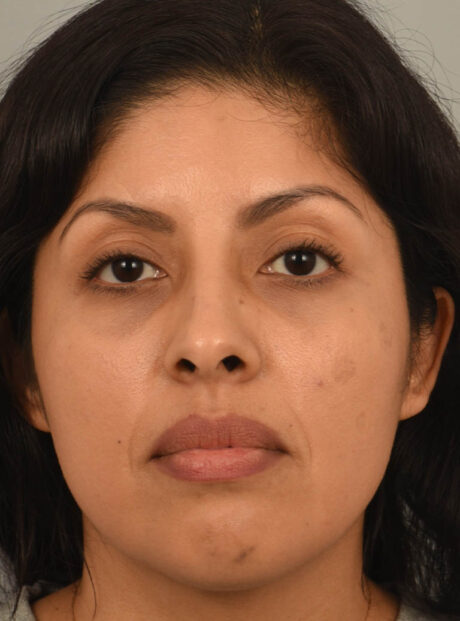 Rhinoplasty case #11710