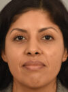 Rhinoplasty case #11710