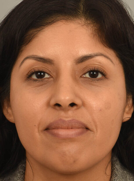 Rhinoplasty case #11710