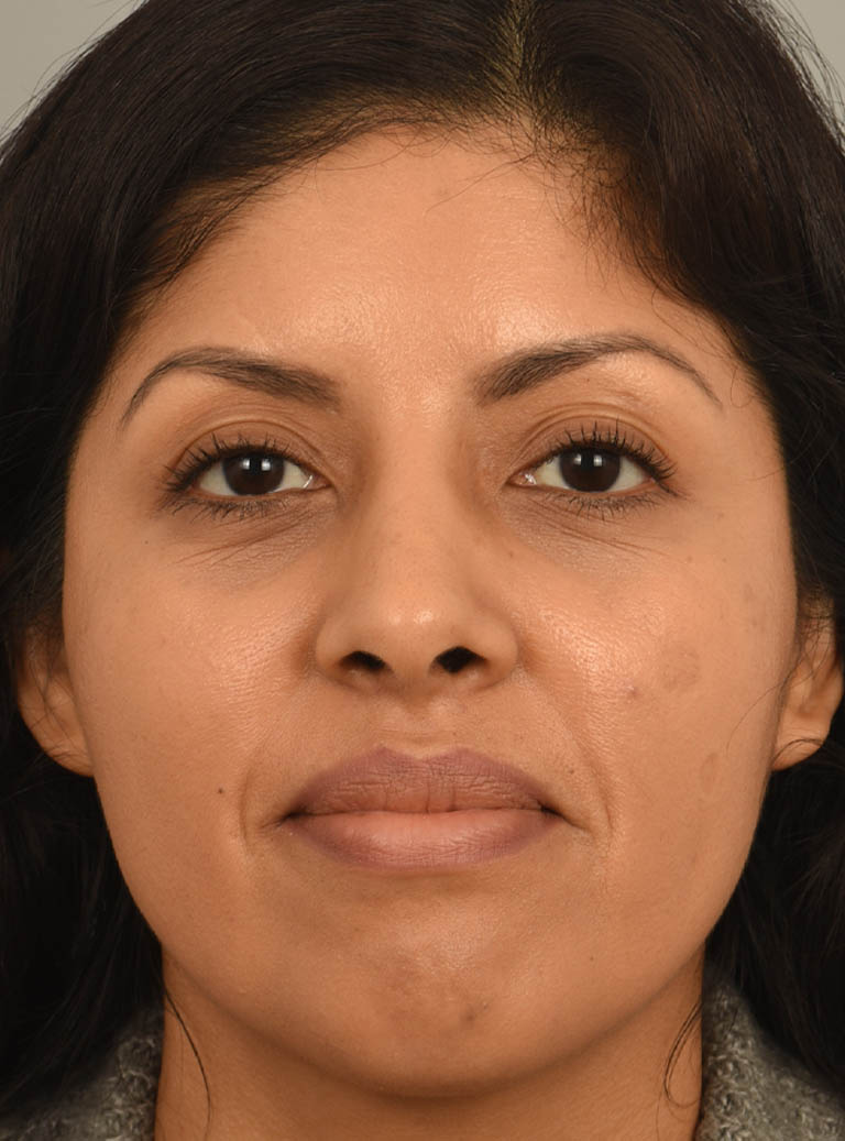 Rhinoplasty case #11710