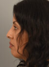 Rhinoplasty case #11710