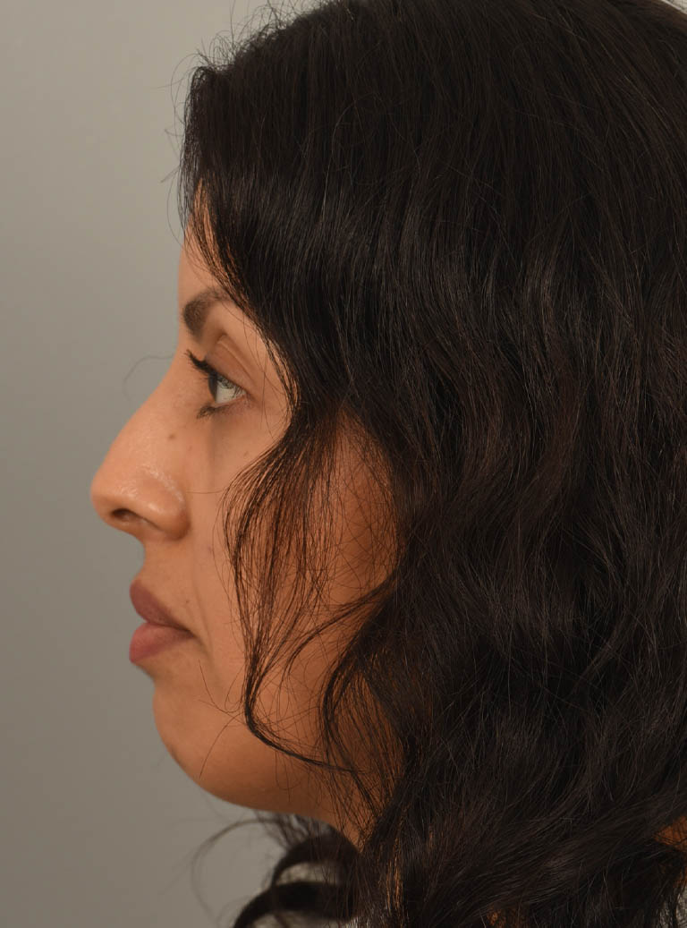 Rhinoplasty case #11710