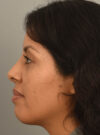 Rhinoplasty case #11710