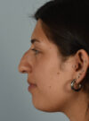 Rhinoplasty case #11715