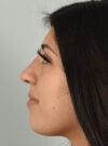 Rhinoplasty case #11715