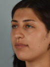 Rhinoplasty case #11715