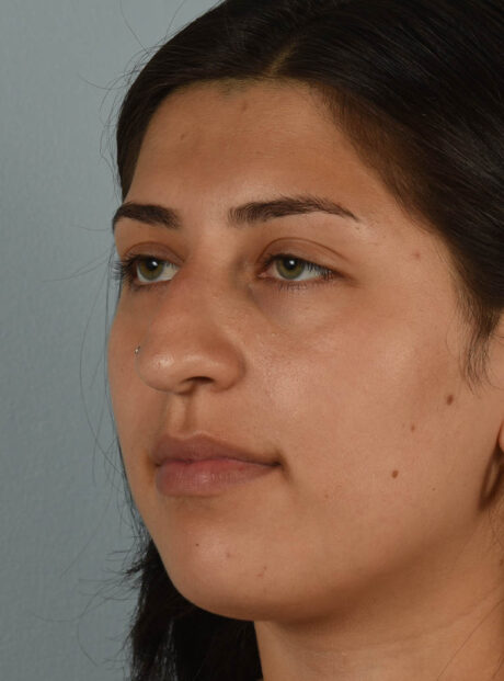 Rhinoplasty case #11715